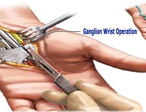 Ganglion Cyst Wrist Surgery
